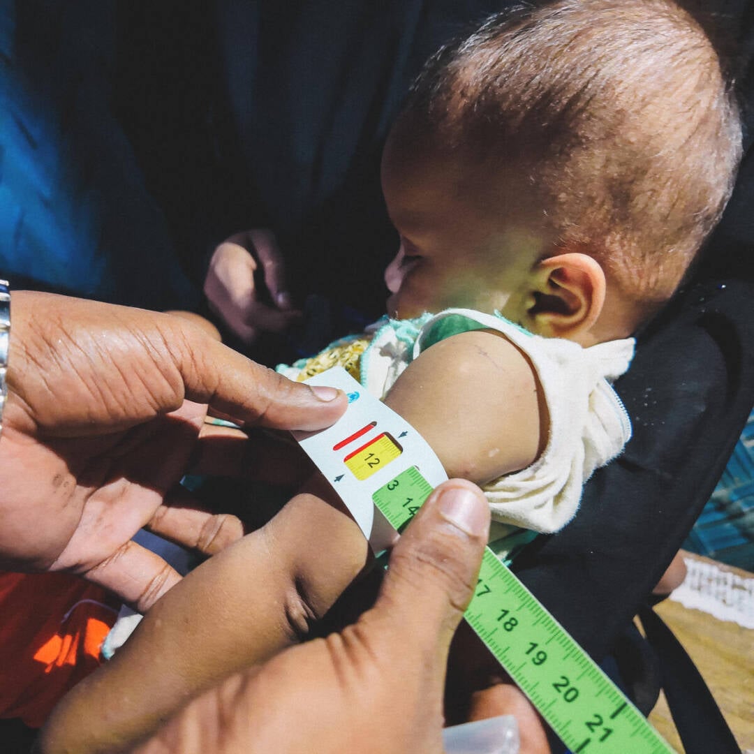 Health worker measures a young child&rsquo;s arm with MUAC tape while the child is held by her mother. The tape shows yellow, indicating moderate acute malnutrition.